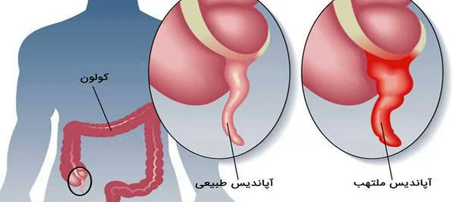 این بیماری را با مشکلات گوارشی اشتباه نگیرید!