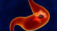 عفونت مجاری ادراری (UTI) باعث یبوست و نفخ میشود؟