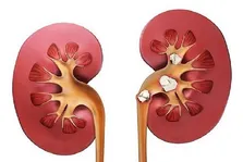 کاهش یک گرم نمک در روز ریسک بیماری قلبی را کاهش می دهد