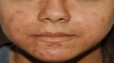 ضروری‌ترین آزمایش‌های پیش از بارداری/ تاکید بر مشاوره ژنتیک در زوجینی با نسبت فامیلی