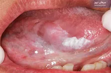 تاثیر ژنتیک در ابتلا به سرطان