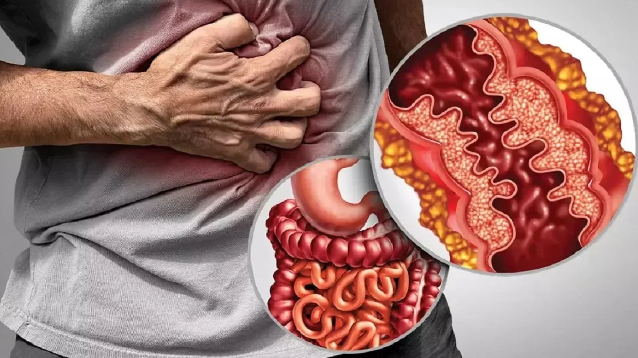 آزمایش خون می‌تواند بیماری کرون را تشخیص دهد؟
