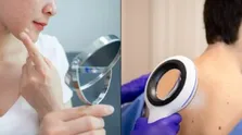 افزایش ۴ برابری احتمال سرطان تخمدان در زنان مبتلا به اندومتریوز
