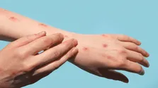 آبله میمون یک وضعیت اضطراری بهداشت عمومی در ایالات متحده
