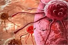 پیشگیری از سرطان ریه با ابداع یک تکنیک جدید