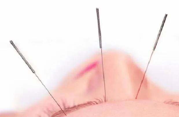 طب سوزنی در کاهش سردردهای تنشی موثر است