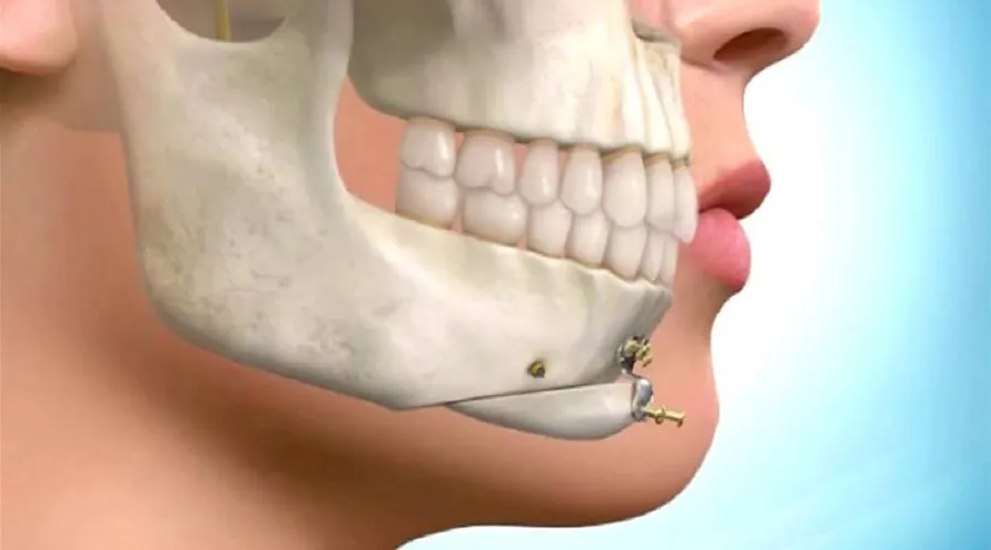 بازسازی فک و صورت با آخرین تکنولوژی شبیه‌سازی عمل جراحی