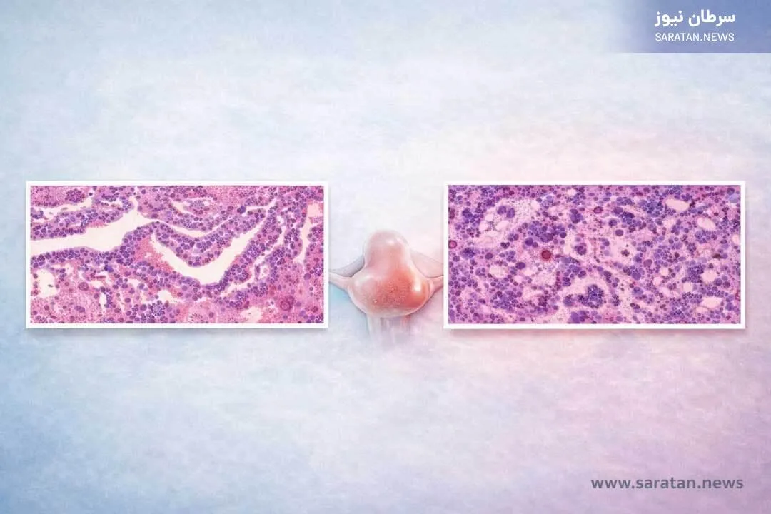 مقایسه Low-Grade و High-Grade Serous Carcinoma از دید پاتولوژی