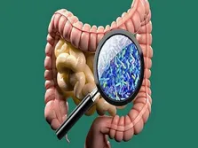 شیرین کننده‌های مصنوعی موجب سرطان می‌شوند