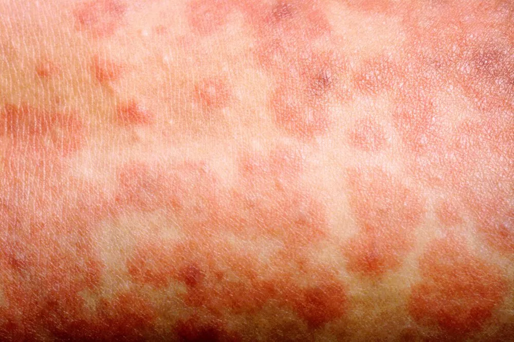 افزایش سه برابری موارد سرخک در ایالات متحده