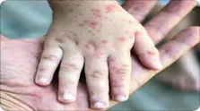 افزایش سه برابری موارد سرخک در ایالات متحده