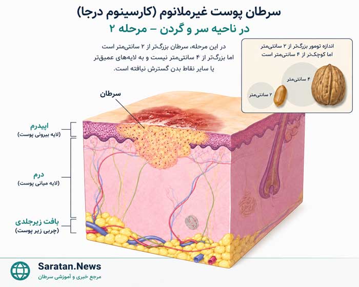 شکل. سرطان پوست غیرملانومی سر و گردن در مرحله II: در این مرحله، اندازه تومور بیش از ۲ سانتیمتر و حداکثر ۴ سانتیمتر است. شکل. سرطان پوست غیرملانومی سر و گردن در مرحله II: در این مرحله، اندازه تومور بیش از ۲ سانتیمتر و حداکثر ۴ سانتیمتر است.
