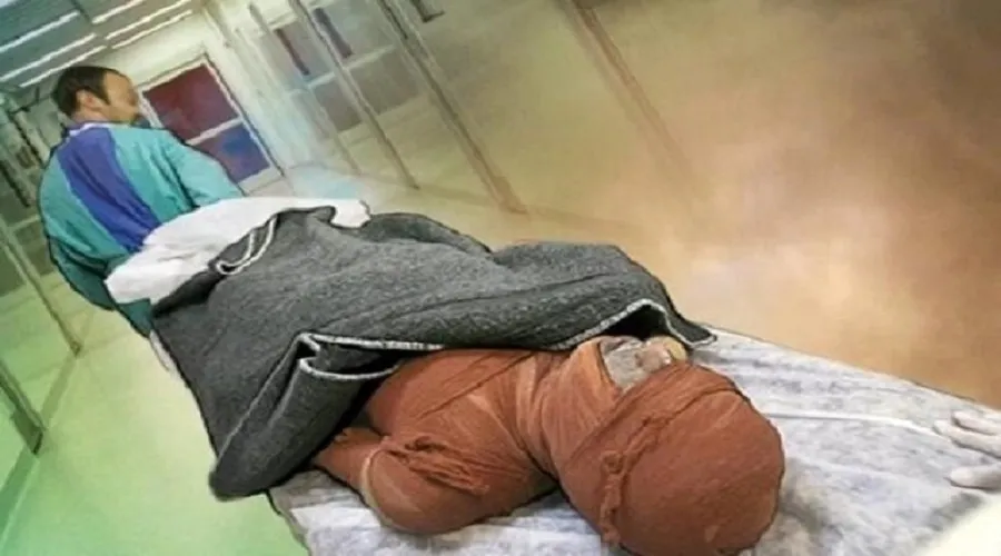 یک کمپلکس مولکولی به کمک بیماران دچار سوختگی می‌آید