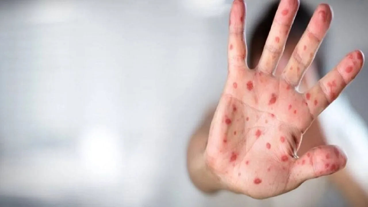 وضعیت عمومی بیمار مبتلا به آبله میمونی در اهواز مناسب است