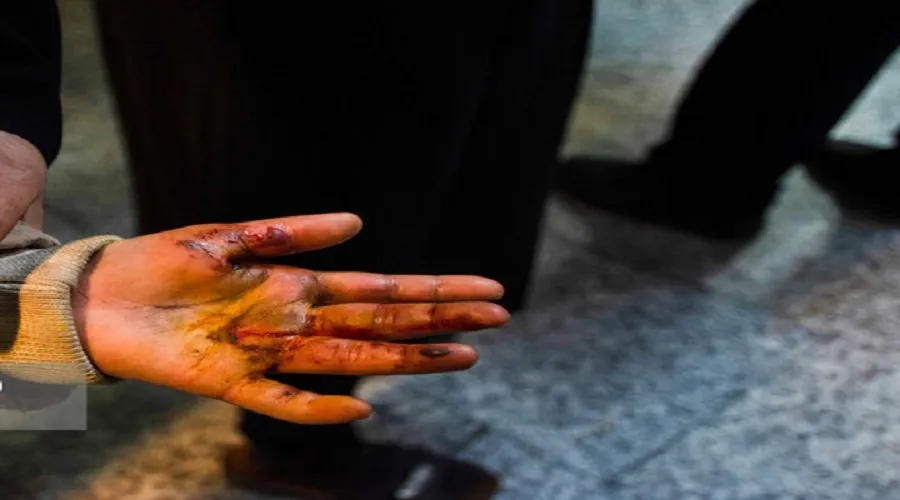 اقدامات اورژانسی در مواجهه با فردی که دچار سوختگی شده است
