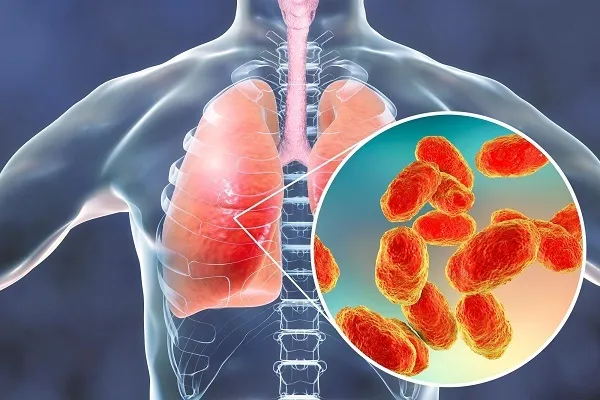 تغییرات اقلیمی با بروز بیشتر عفونت های ریوی قارچی مرتبط است