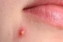 ضروری‌ترین آزمایش‌های پیش از بارداری/ تاکید بر مشاوره ژنتیک در زوجینی با نسبت فامیلی