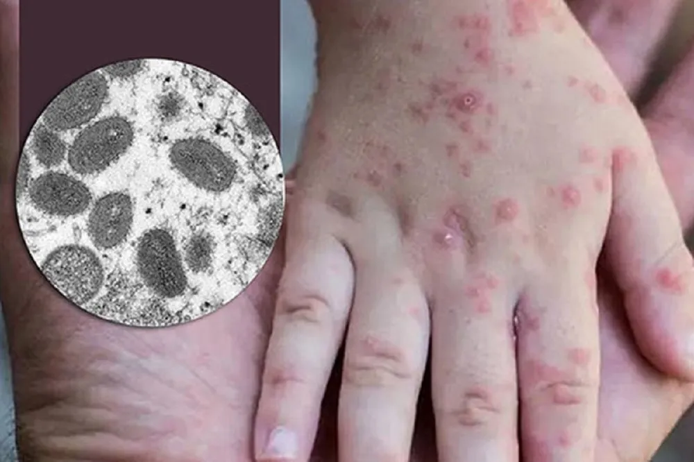 شباهت علائم آبله میمونی و آبله مرغان / نحوه نمونه گیری از افراد مشکوک به بیماری