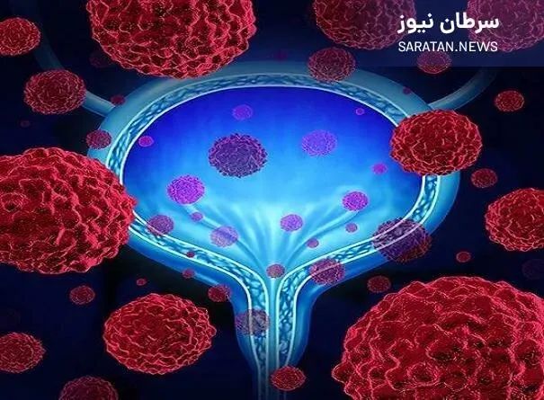 مطالعه VOLGA؛ گامی استوار به سوی درمان هدفمند سرطان مثانه