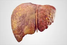 پیش‌بینی خطر ابتلا به سرطان کبد با آزمایش خون ساده