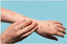 «آبله آلاسکایی»؛ از علائم تا چگونگی گسترش