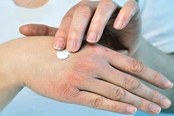 ۷ ماده غذایی برای مقابله با خشکی پوست در فصول سرد