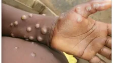 هنوز موردی از ابتلای قطعی به آبله میمون در ایران مشاهده نشده است