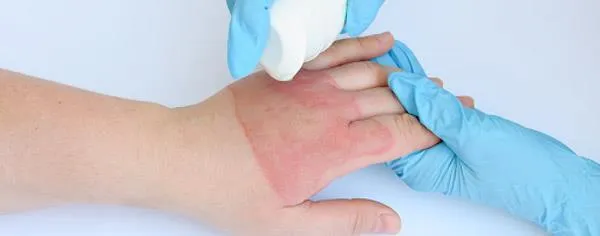 چند نکته در مورد سوختگی