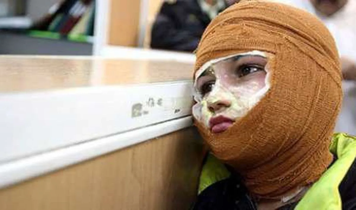 کمبود بیش از ۱۰۰۰ تخت سوختگی در کشور/پوشش بیمه‌ای ضعیف درمان سوختگی