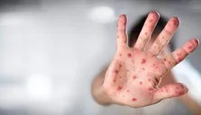 هشدار پزشکان درمورد یک بیماری مسری در میان کودکان