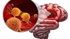 آیا ایمونوتراپی در گلیوبلاستوما می‌تواند جایگزین شیمی‌درمانی استاندارد شود؟