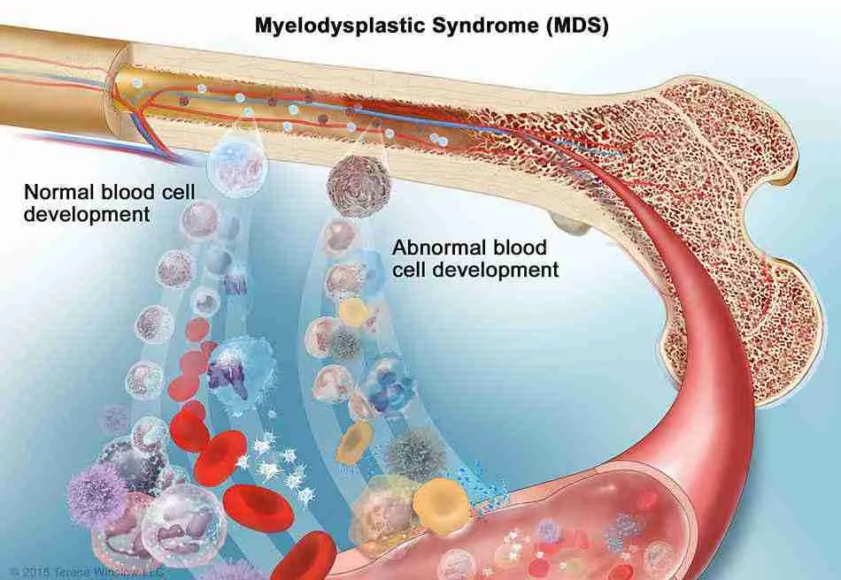 آیا مواد حاجب رادیولوژی باعث سندرم میلودیسپلاستیک (MDS) می‌شوند؟