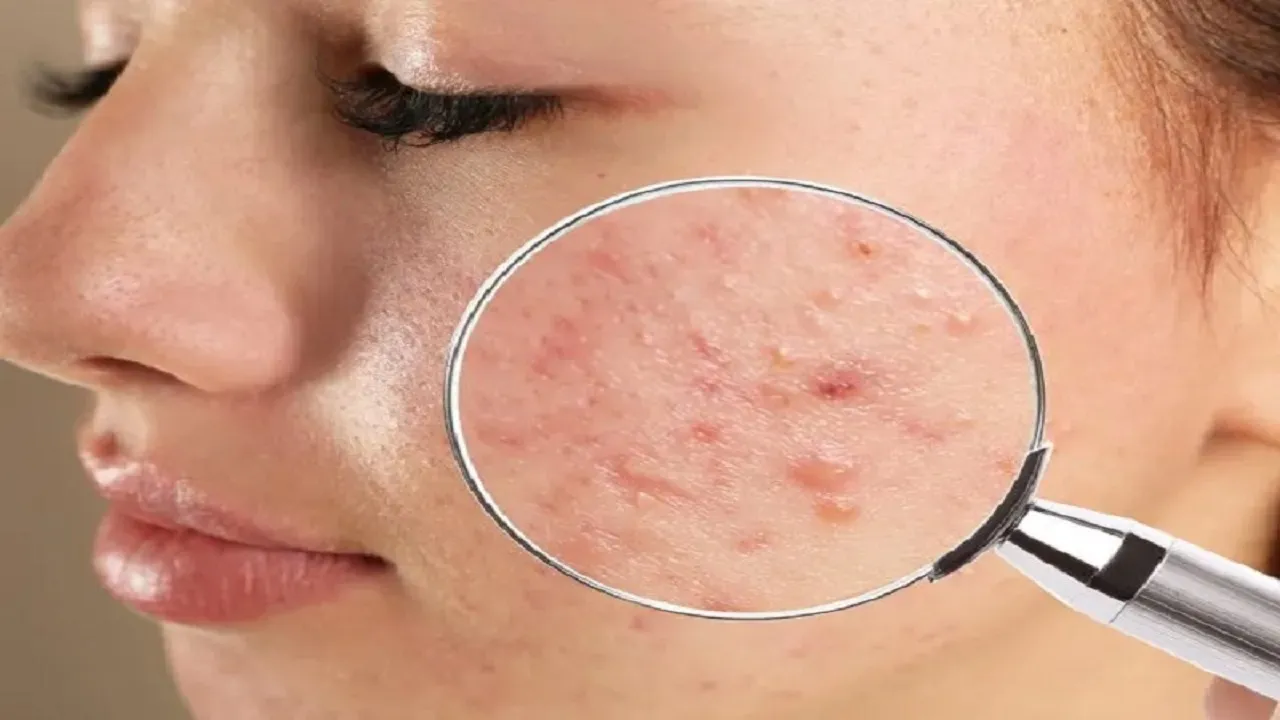 رژیم غذایی برای کنترل آکنه هورمونی: چه بخوریم و چه نخوریم؟