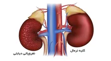 خواص فوق العاده خوردن پودر حنا برای سنگ کلیه و کبد