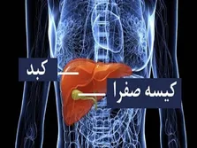 چاقی دومین علت ایجاد سنگ صفرا در دنیا + فیلم