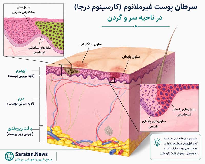 شکل ۳. سرطان پوست غیرملانومی سر و گردن (کارسینوم درجا): در این مرحله، سلولهای غیرطبیعی در لایه سلولهای سنگفرشی یا لایه سلولهای بازال اپیدرم دیده میشوند. این سلولها ممکن است در آینده به سلولهای سرطانی تبدیل شوند و به بافتهای سالم مجاور گسترش یابند. شکل ۳. سرطان پوست غیرملانومی سر و گردن (کارسینوم درجا): در این مرحله، سلولهای غیرطبیعی در لایه سلولهای سنگفرشی یا لایه سلولهای بازال اپیدرم دیده میشوند. این سلولها ممکن است در آینده به سلولهای سرطانی تبدیل شوند و به بافتهای سالم مجاور گسترش یابند.