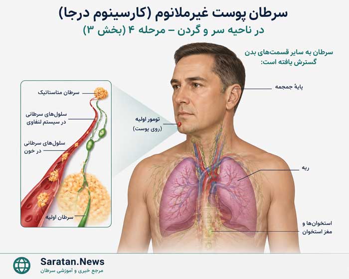 سرطان پوست چیست؟ علائم، علل، تشخیص و جدیدترین روشهای درمان سرطان پوست سرطان پوست چیست؟ علائم، علل، تشخیص و جدیدترین روشهای درمان سرطان پوست