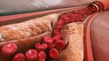 نقش کم خوابی در ابتلا به آلزایمر