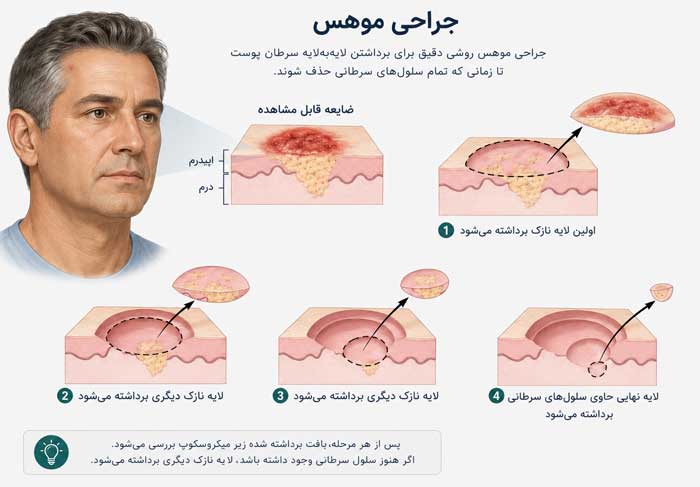سرطان پوست چیست؟ علائم، علل، تشخیص و جدیدترین روشهای درمان سرطان پوست سرطان پوست چیست؟ علائم، علل، تشخیص و جدیدترین روشهای درمان سرطان پوست