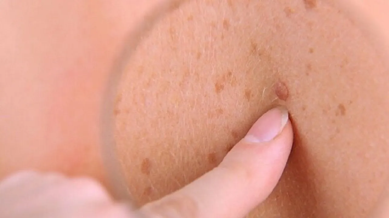 خال ها چه زمانی خطرناک می شوند؟