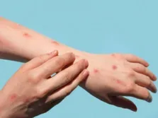 آمار به‌روز شده فوتی‌های آبله میمونی در جهان
