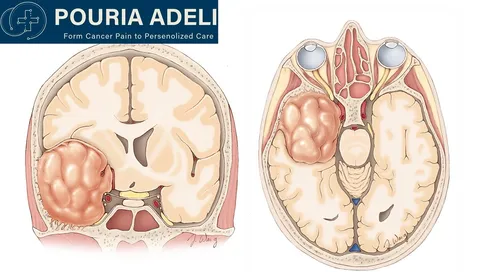 نقش آلودگی هوا در ابتلا به مننژیوم
