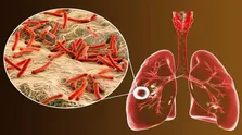 چگونه از بیماری سل پیشگیری کنیم؟ + فیلم