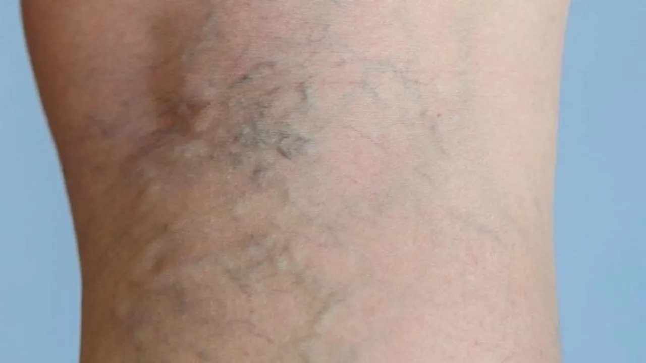 با چند عادت ساده از ابتلا به واریس پیشگیری کنیم