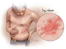 از آبله میمونی چه می دانید؟