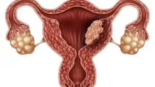 چرا برخی تست‌های HPV مثبت، بعداً منفی می‌شوند؟