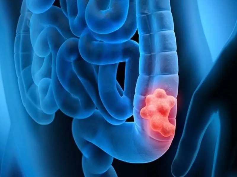 چگونه از سرطان معده جلوگیری کنیم؟ + فیلم