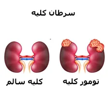 ترکیب جدید درمان سرطان کلیه: نتایج امیدوارکننده از ترکیب سلنو-ال-متیونین و اکزیتینیب