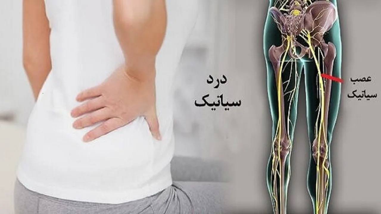 سیاتیک را با گرفتگی عضلات اشتباه نگیرید